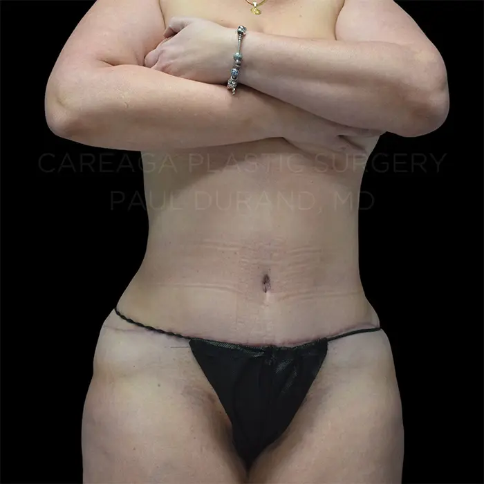 Tummy Tuck — after, actual Careaga patient