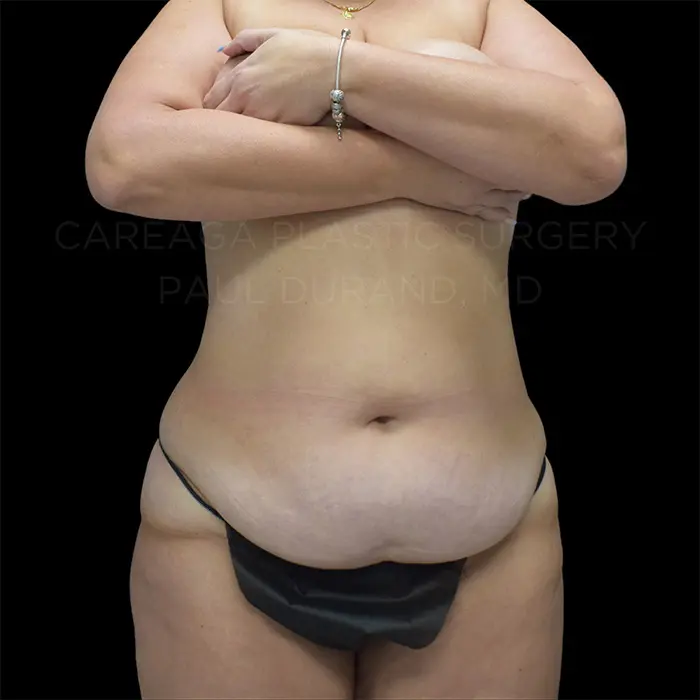 Tummy Tuck — before, actual Careaga patient