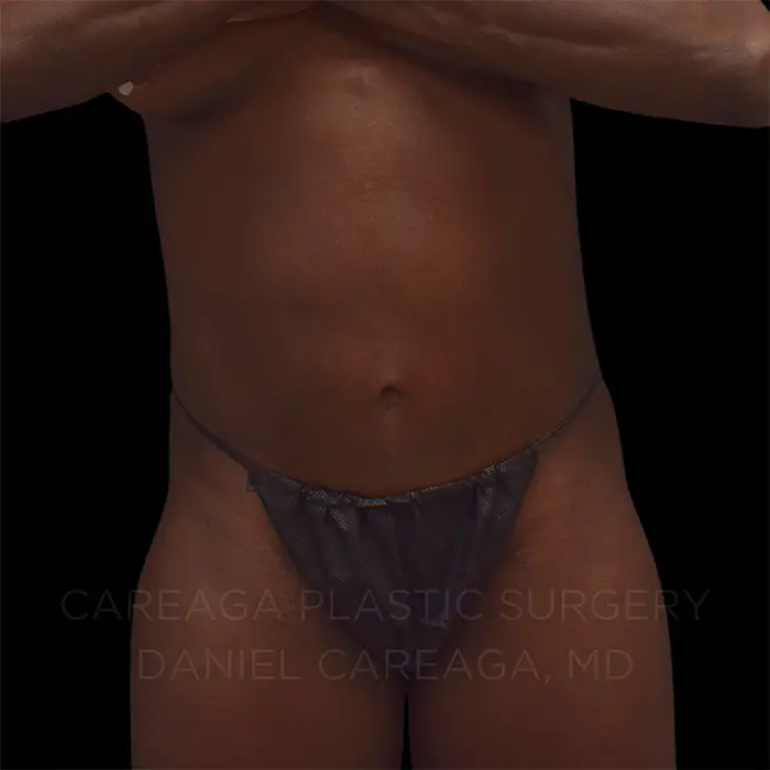 Tummy Tuck — after, actual Careaga patient