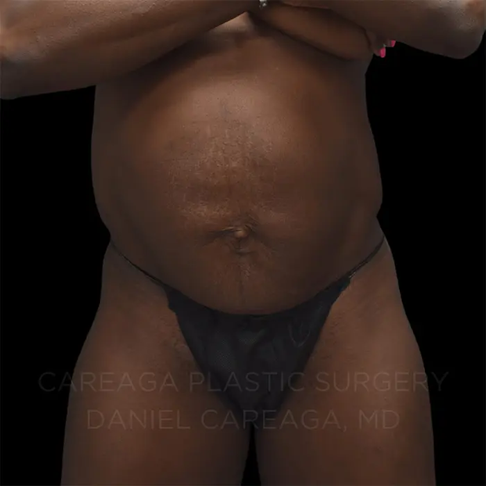 Tummy Tuck — before, actual Careaga patient