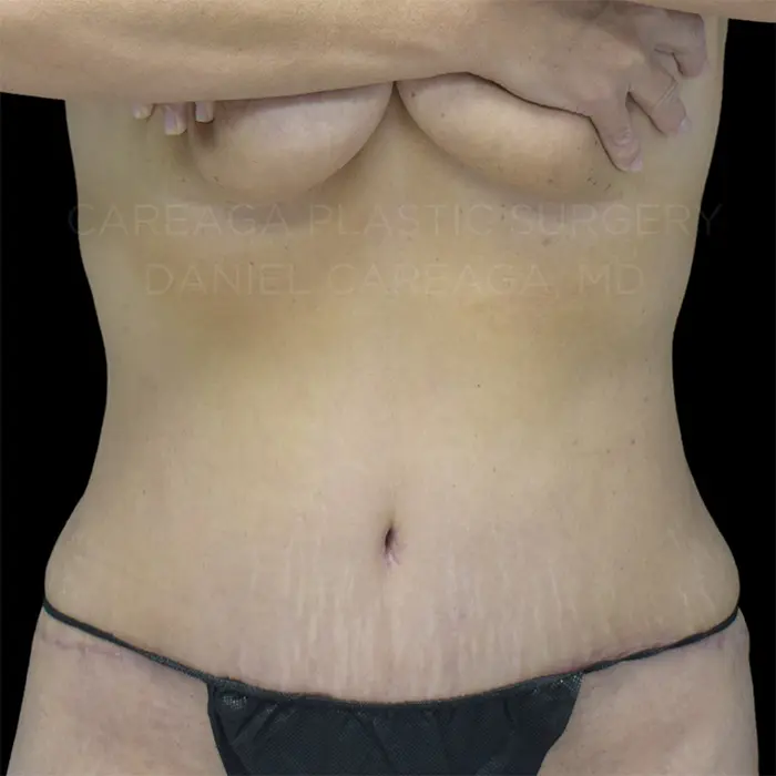 Tummy Tuck — after, actual Careaga patient