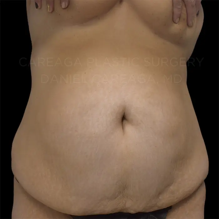 Tummy Tuck — before, actual Careaga patient